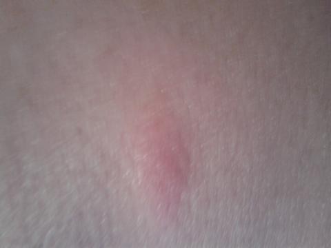 Podezreni na syfylis